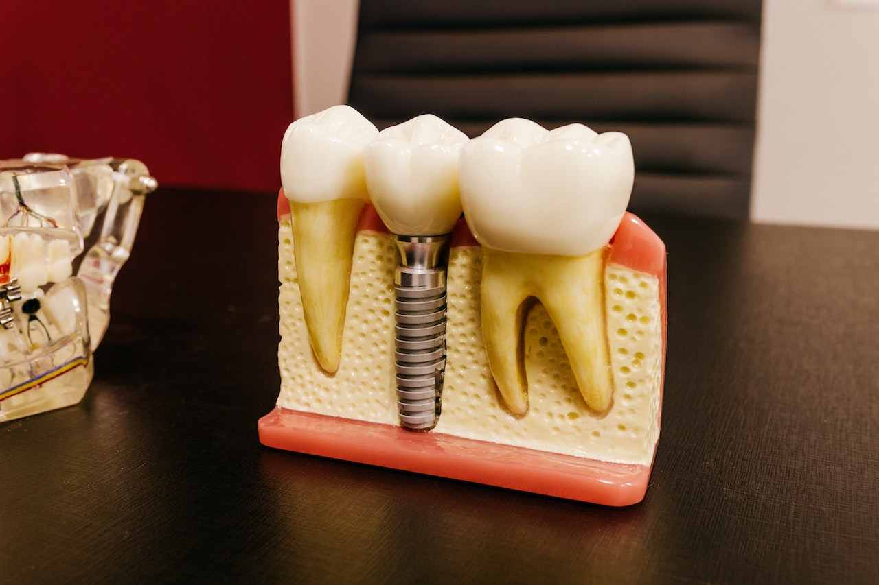 5 Signs You May Need Dental Implants